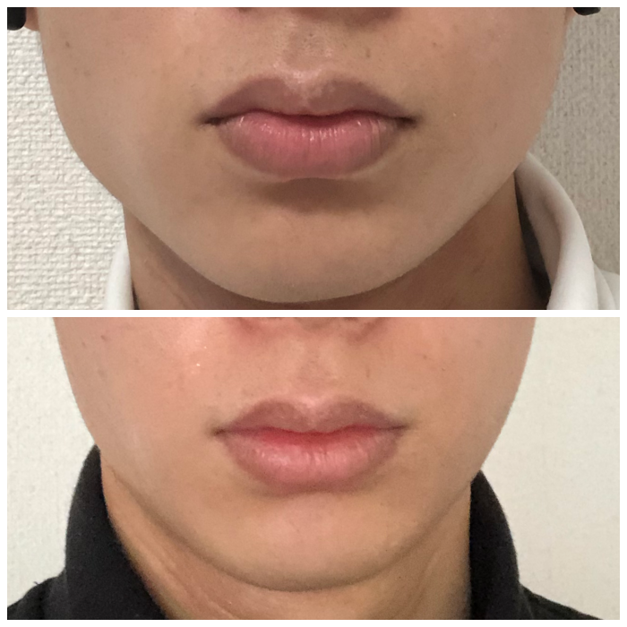 男のエラボトックスは変 メンズがエラボトを受けるべき3つの理由 フランケンの美容整形ブログ